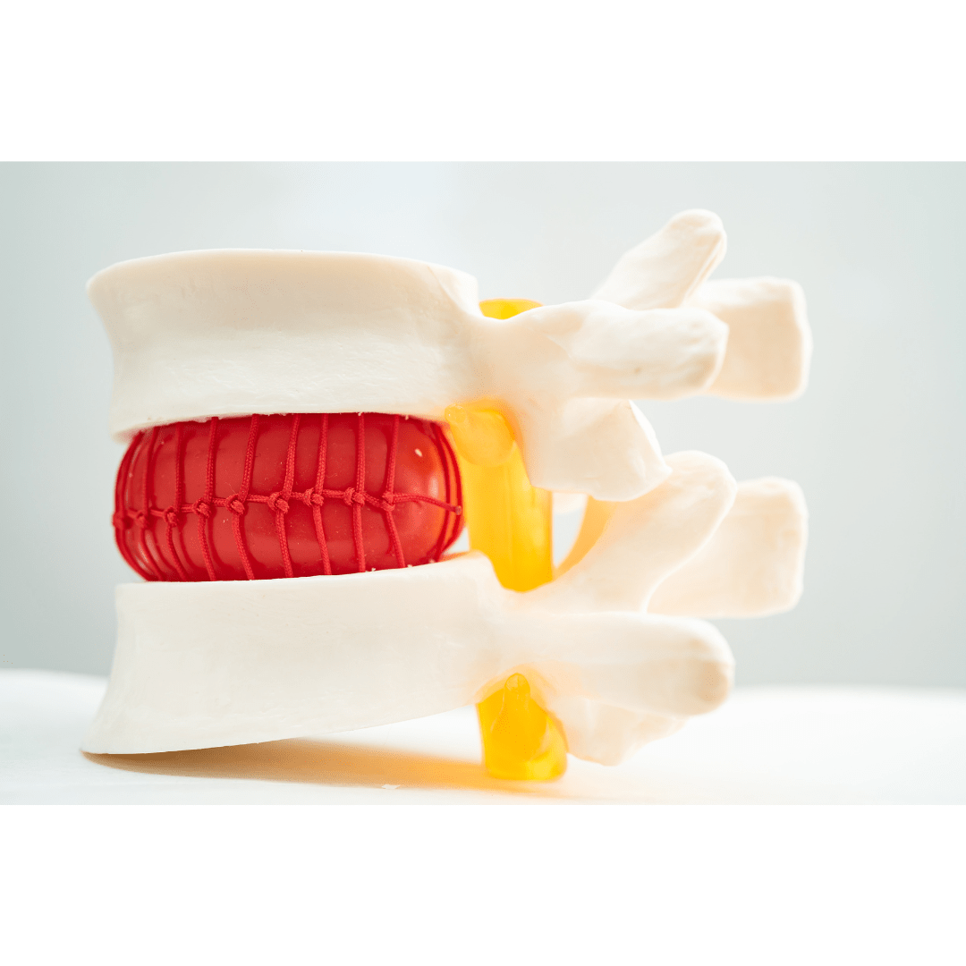 Sciatica